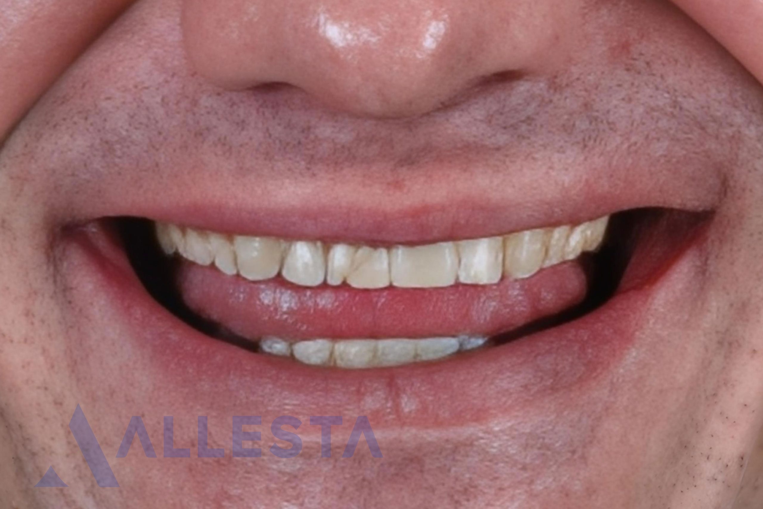 Before and after1-01