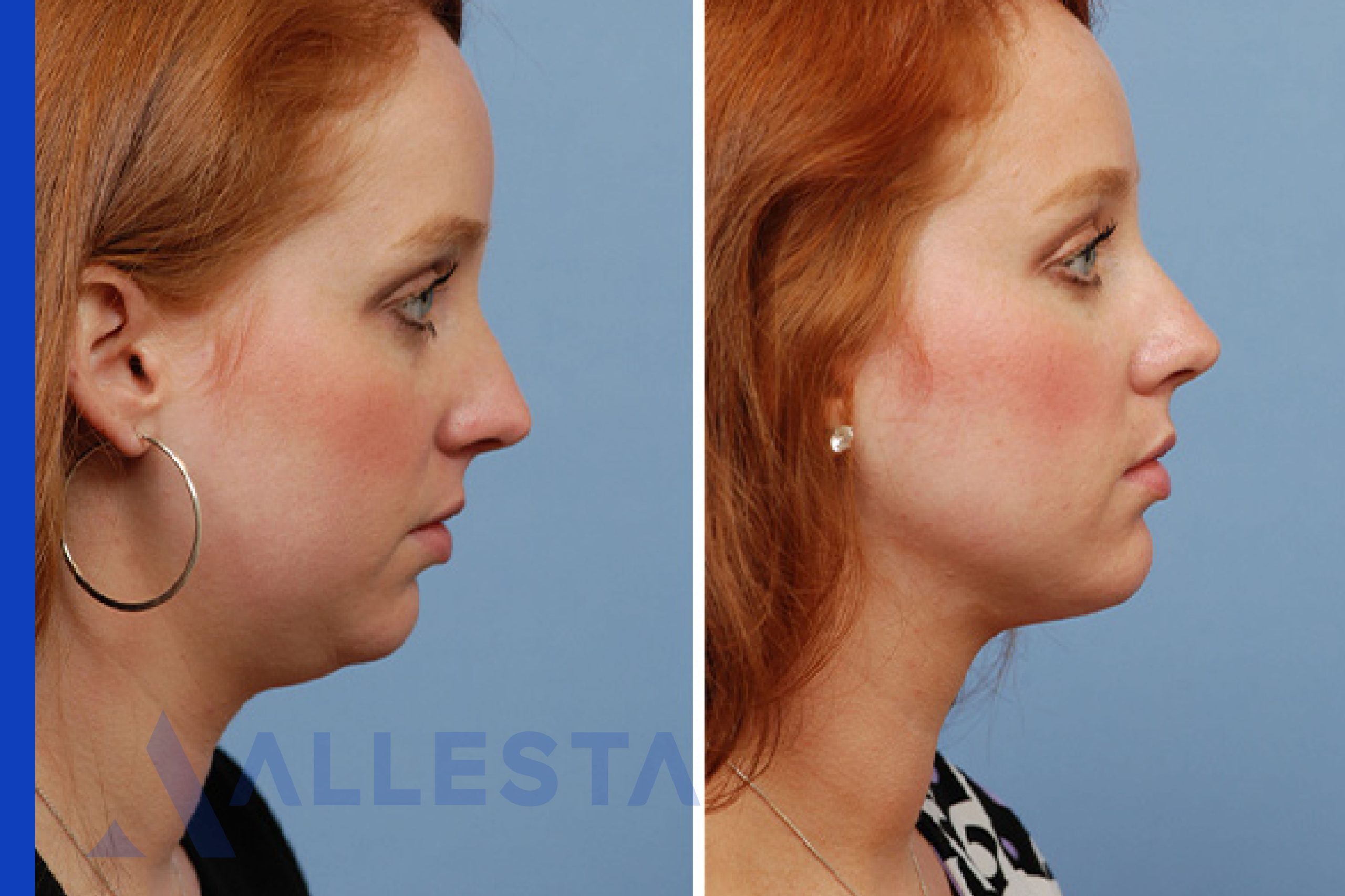 Before and after3-01