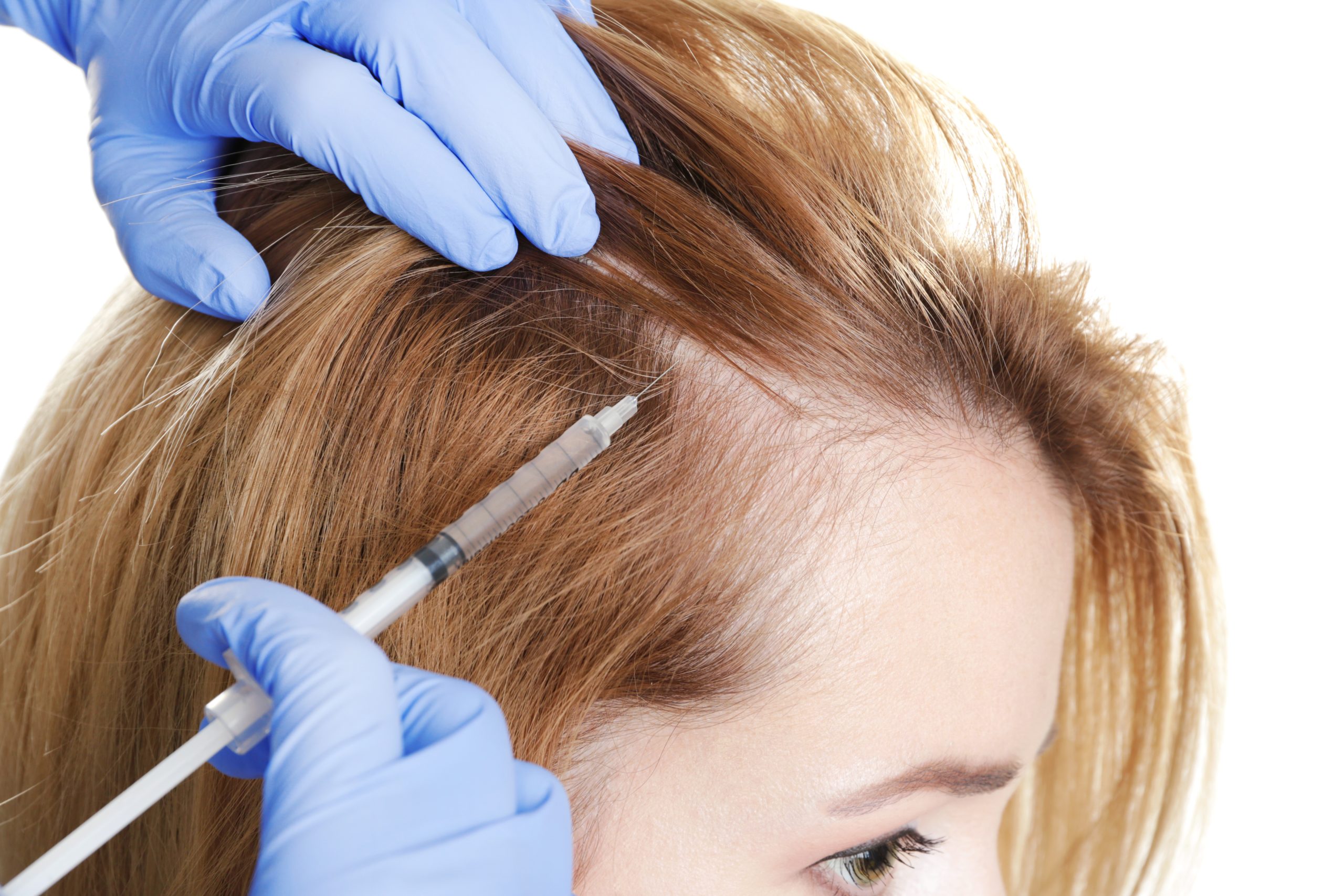 Female Hair Transplant