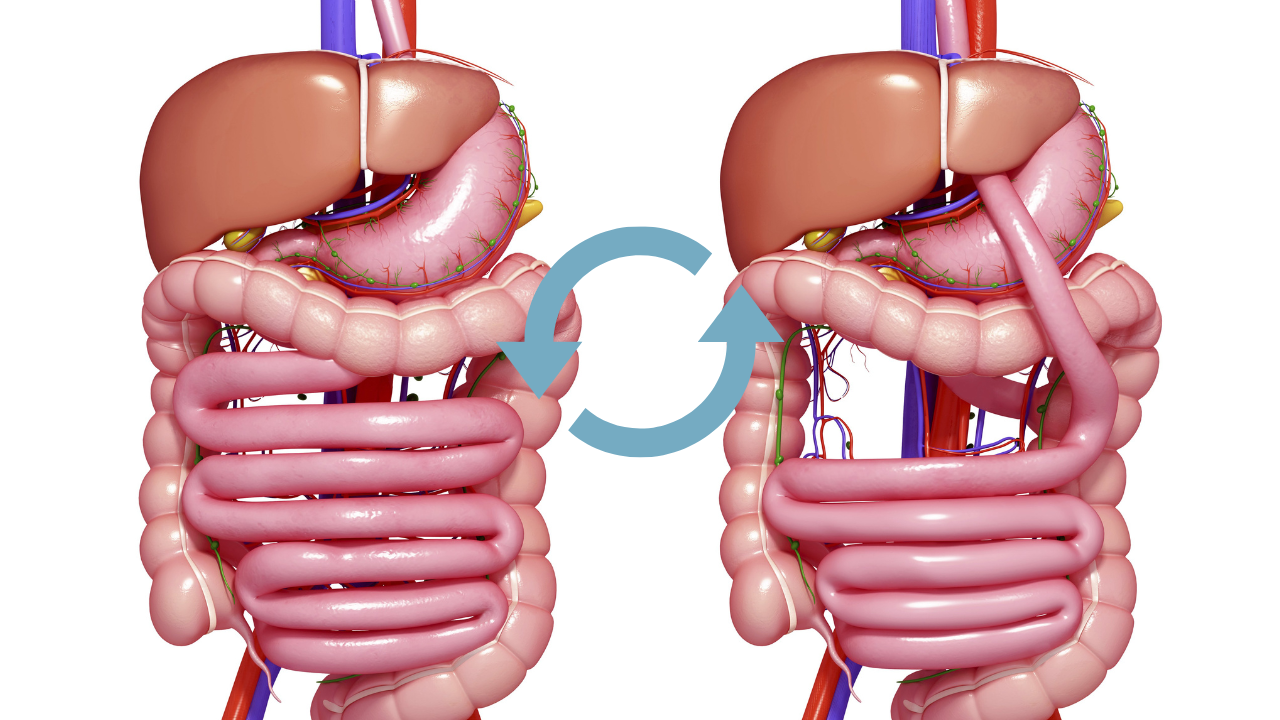 Revision/Reverse Bariatric Surgeries