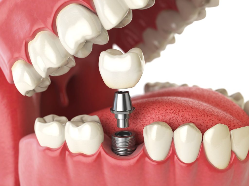 Dental Implants cost