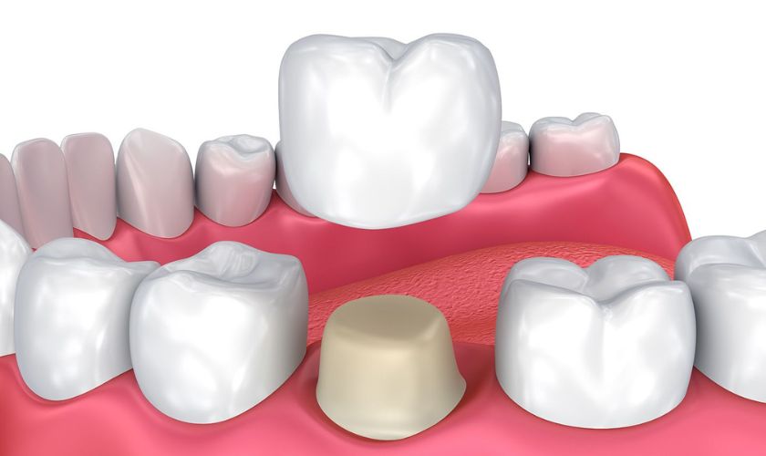 Dental Crowns