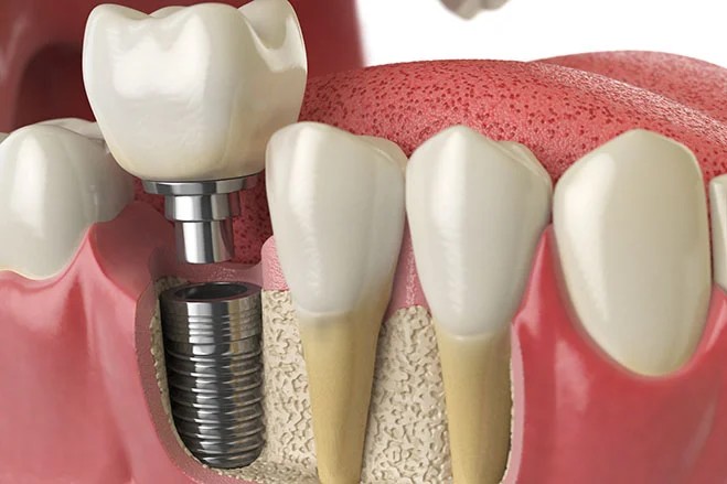 Dental Implants