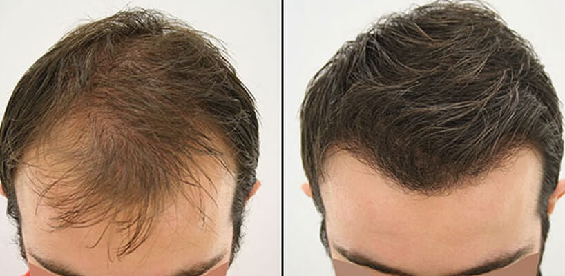 Before After Turkish Hair Transplant 