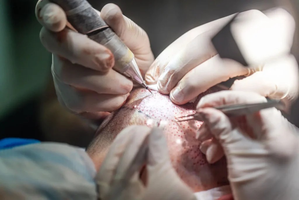 Best Sapphire Hair Transplant in Istanbul