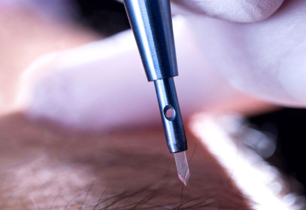 Sapphire Hair Transplant Turkey