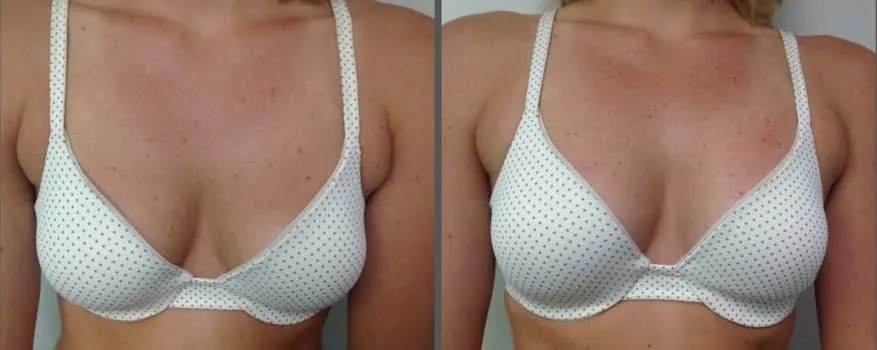 Vampire Breast Lift Before and After picture
